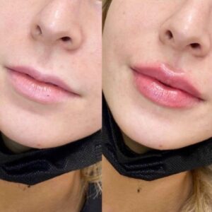 Lip Volumisation