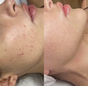 IPL Acne Management